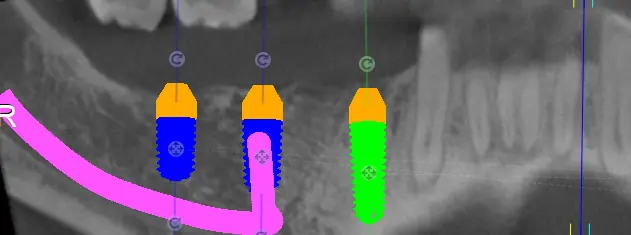 CBCT multi-implant plan with inferior alveolar nerve canal traced in pink, prepared by MyNaviScan in Chicago