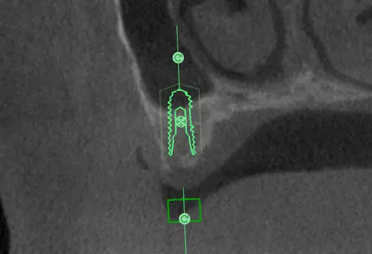 Sinus lift CBCT plan showing implant trajectory, Schneiderian membrane and sinus floor, by MyNaviScan in Chicagoland