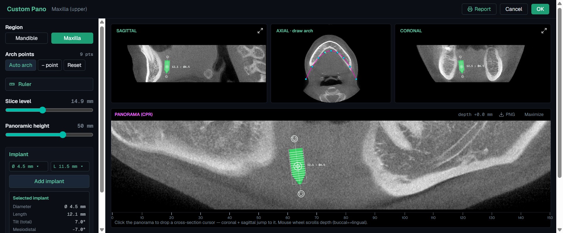Dental implant planning in the MyNavi CBCT viewer — a virtual 4.5 mm implant placed on a panoramic (CPR) reconstruction with millimetre measurements and cross-section slices