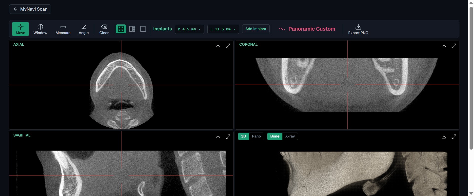 MyNavi CBCT viewer showing axial, coronal and sagittal MPR slices with a 3D volume render of a dental cone-beam CT scan, running in a web browser